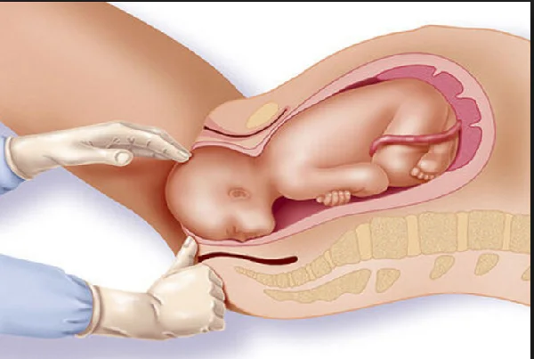 Normal Vaginal Delivery